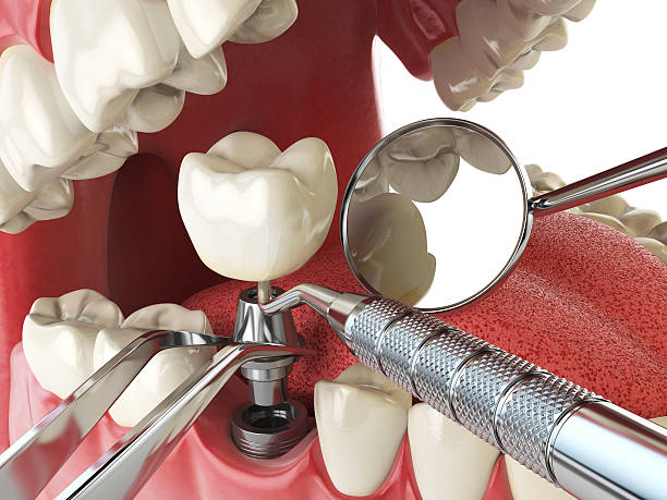Best Emergency Dentist for Lost Fillings or Crowns in Farmersburg, IN